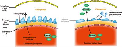 Urinary biomarkers associated with podocyte injury in lupus nephritis